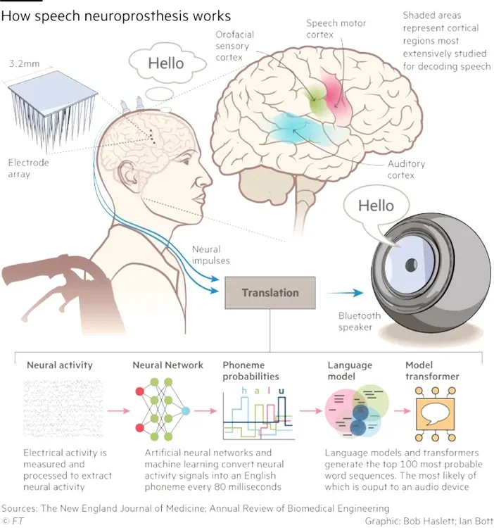 voice-prosthesis-chema.webp